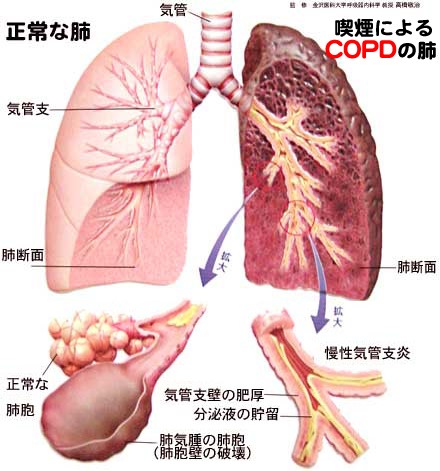 喫煙によるCOPDの肺